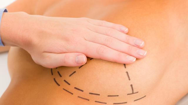 registratie-iedere-borstprothese (1)